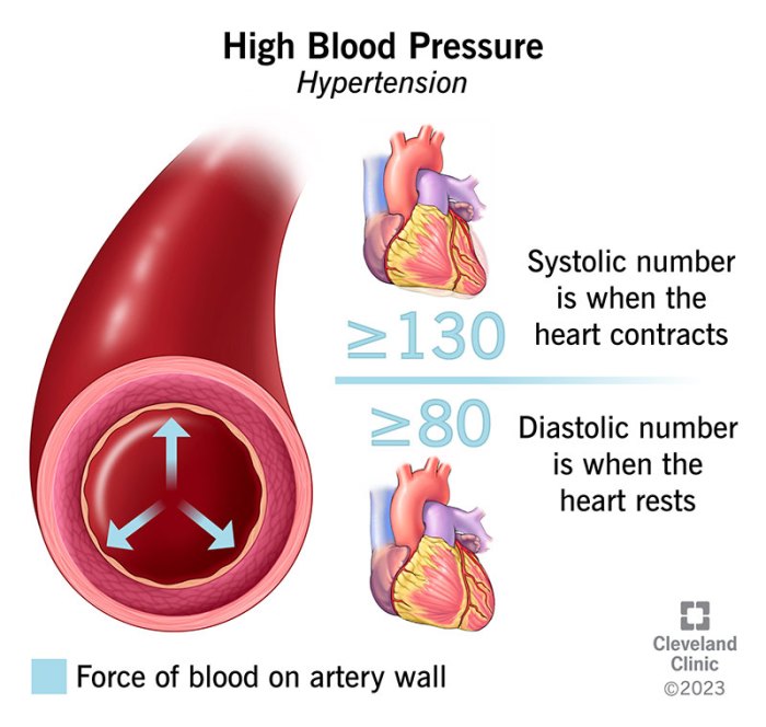 Hypertension and high blood pressure