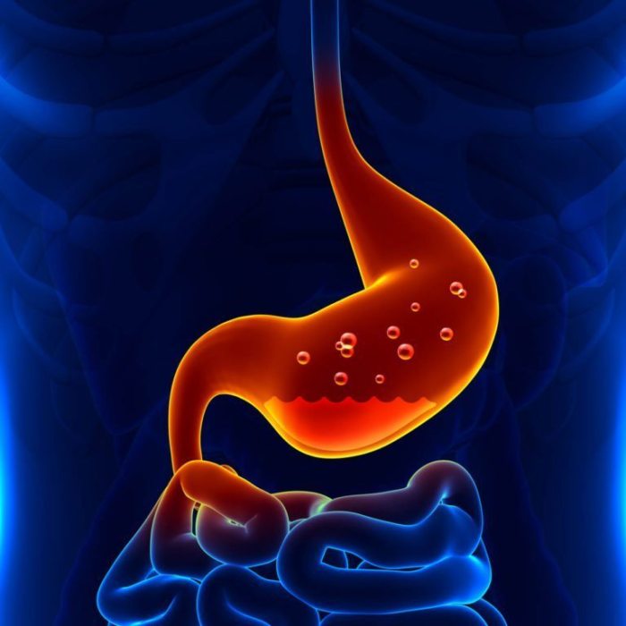 Acid reflux surgery options